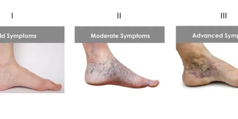 Three images of feet labeled "I. Mild Symptoms," "II. Moderate Symptoms," and "III. Advanced Symptoms," showing the progression of what appears to be a medical condition.