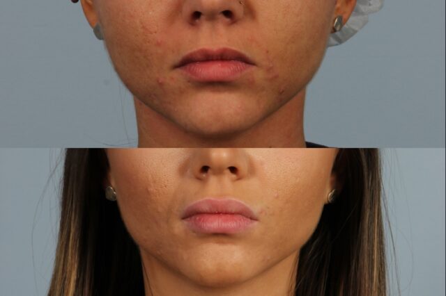 Two close-up images of a woman's lower face are shown. The top image shows acne on the cheeks and chin. The bottom image shows clearer skin on the same area.