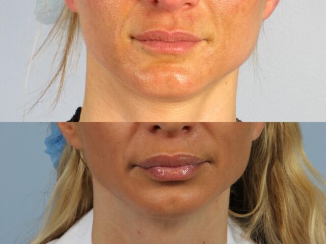 Two side-by-side images showing a woman's face: top image displays her skin before a facial treatment, and the bottom image shows her skin after the treatment with a noticeable improvement in tone and texture.