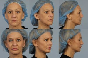 Six portrait-style photographs of a woman wearing a blue surgical cap, shown from the front, three-quarter angles, and side profiles, both before (top row) and after (bottom row) a medical procedure.