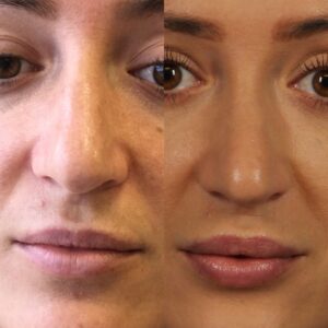 Side-by-side comparison image showing a woman's face before and after a skin treatment. The left side shows a natural complexion, while the right side shows smoother and more even-toned skin.