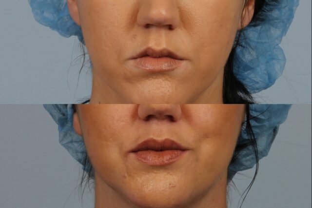 Close-up of a woman's lower face before and after a cosmetic procedure. She is wearing a blue surgical cap in both images. The second image shows fuller and more defined lips.