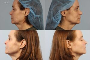 Side-by-side comparison of a woman's profile before (top) and after (bottom) undergoing a medical procedure, with the images dated January 2016. She wears a blue hair cap in the top images.