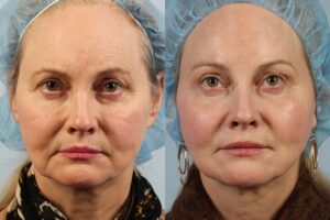Side-by-side images of a woman before and after a cosmetic procedure. The left image shows her with visible wrinkles and sagging skin. The right image shows smoother skin and a more youthful appearance.