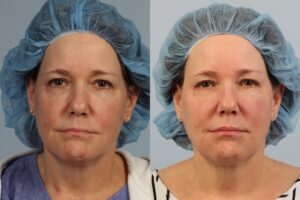 Side-by-side comparison of a woman wearing a blue hair cover before and after a procedure, showing noticeable changes in skin tone and texture.