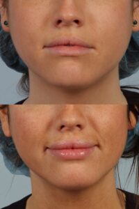 Close-up of a person's face before (top) and after (bottom) receiving lip enhancements. The top image shows thinner lips, and the bottom image shows fuller lips with a glossy finish.