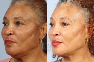 Two side-by-side images showing a woman's face before (left) and after (right) a cosmetic treatment, highlighting reduced wrinkles and improved skin tone. She is wearing a red lipstick and gold earrings.