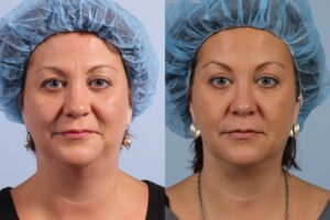 Side-by-side comparison of a woman before and after a cosmetic procedure, both images show her wearing a blue surgical cap and facing the camera with a neutral expression.