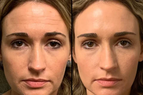 Side-by-side comparison of a woman's face before (left) and after (right) treatment, showing reduction in forehead wrinkles and smoother skin.