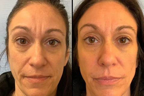 Side-by-side images of a woman, with the left showing her face before a treatment and the right showing her face after the treatment. Her skin appears smoother and less wrinkled in the "after" image.