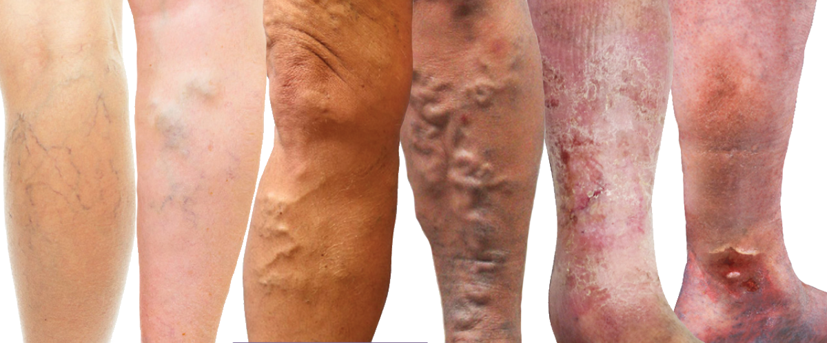 Four legs with varying conditions of varicose veins, visible swelling, and skin discoloration.