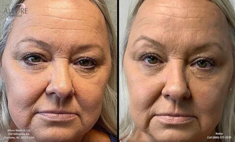 Portraits of a woman before (left) and after (right) Botox treatment. The image shows visible differences in skin smoothness and wrinkle reduction.