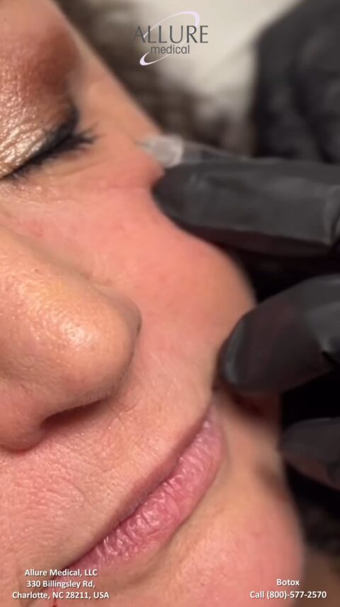 Close-up of a person receiving a Botox injection near the eye at Allure Medical, LLC in Charlotte, NC. The injector is wearing black gloves. Contact information is visible at the bottom.