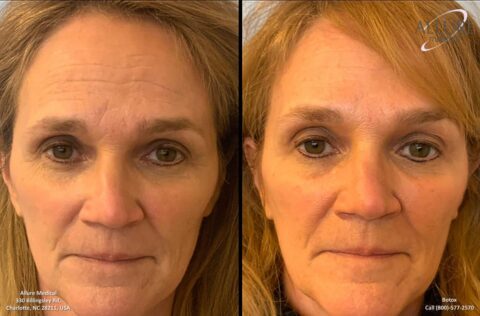 Before and after images of a woman's face showing visible improvements in skin texture. The left image is labeled "Allure Medical." The right image shows smoother skin. Contact number is provided.