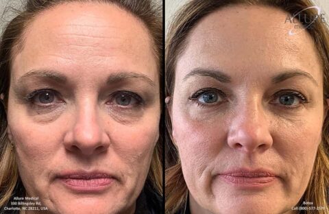 Side-by-side comparison of a woman's face before and after a cosmetic procedure, showing improvement in skin tone and reduced appearance of wrinkles and under-eye bags.