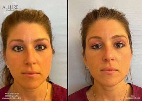 Side-by-side comparison of a woman before (left) and after (right) a cosmetic procedure, displaying noticeable changes in facial appearance. Logos and contact information are present.