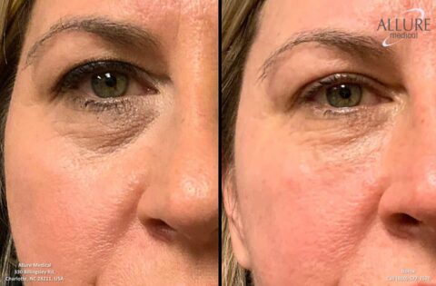 Close-up comparison of a woman's eye area before (left) and after (right) receiving Botox treatment, showing reduced wrinkles. Branding for "Allure Medical" visible in the top right corner.