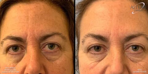 Before and after close-up images showing the effect of an eye treatment on a person's under-eye area. Left image shows prominent under-eye bags; right image shows reduced under-eye bags and smoother skin.