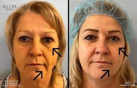 Before and after comparison of a woman's face showing results of botox treatment, with arrows pointing to specific areas of improvement. The left side shows the "before" and the right side shows the "after.