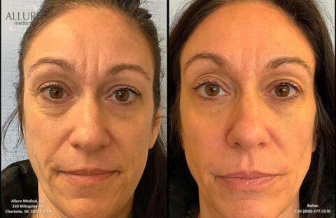 Side-by-side close-up images of a woman's face, showing before and after effects of Botox treatment. The "before" image has more pronounced wrinkles and lines; the "after" shows smoother skin.