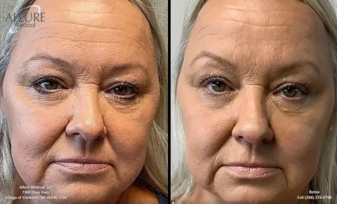 Side-by-side images show a woman’s face before (left) and after (right) a cosmetic procedure to reduce wrinkles and enhance skin smoothness.