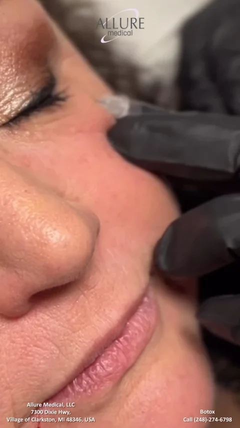 A close-up of a person's face receiving a Botox injection near the eye. The injector is wearing black gloves. The Allure Medical logo and contact information are visible at the bottom.