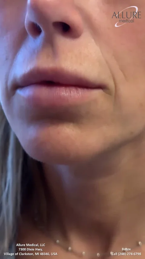 A close-up of a woman's lower half of her face, highlighting her lips. The image includes text advertising Allure Medical, along with contact information and location details.