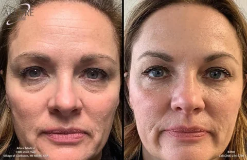 Side-by-side comparison of a woman's face before and after a cosmetic procedure showing reduced under-eye bags and smoother skin.