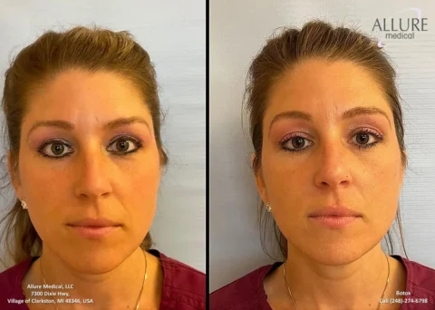 Side-by-side photos of a woman before and after a Botox procedure. The left image shows her with expression lines, while the right image shows a smoother facial appearance.