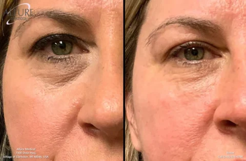 Two close-up images showing the skin around a woman's eye before and after a Botox treatment. The “before” image shows more wrinkles and fine lines compared to the smoother skin in the “after” image.