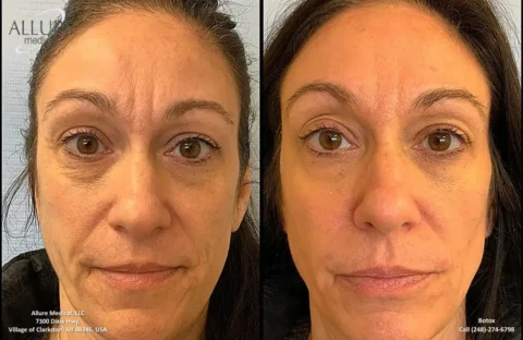 Side-by-side images of a woman's face showing the effects of a botox treatment. The left image is the "before" picture showing more defined wrinkles, and the right image is the "after" picture with smoother skin.