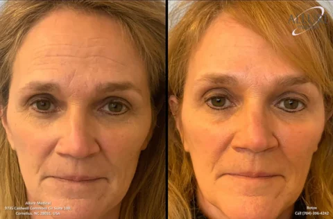 Close-up comparison of a woman's face before and after Botox treatment. The left image shows more wrinkles, while the right image shows smoother skin. Text on the images provides contact details for Allure Medical.