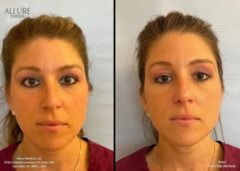 Before and after photos of a woman's face showing Botox treatment results. The left side displays her face before the procedure, and the right side shows her face after the treatment.