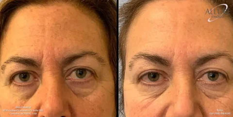 Side-by-side images of a woman's eyes, showcasing a reduction in under-eye bags and wrinkles, presumably before and after a cosmetic treatment from Allure Medical.