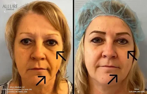 Before and after image of a woman's face showing the effects of Botox treatment, with arrows highlighting changes in wrinkles and lines.