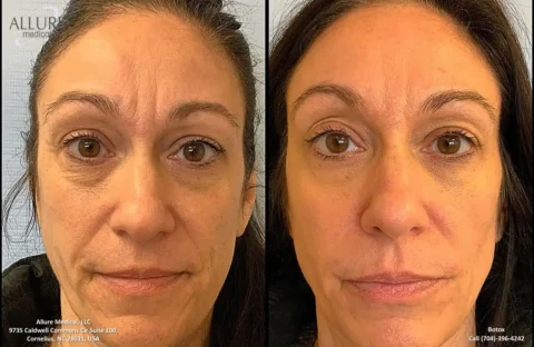 Before and after comparison of a woman’s face showing reduced forehead wrinkles and smoother skin upon receiving Botox treatment. The clinic's information is displayed at the bottom of the image.