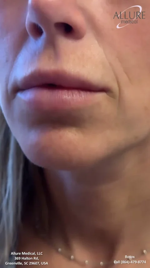 Close-up of the lower half of a person's face, highlighting lips and lower cheeks. Text in the image includes a medical clinic's address in Greenville, SC, and contact information for Botox services.