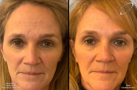 Side-by-side comparison of a woman's face before and after receiving Botox treatment, highlighting reduced wrinkles and smoother skin on the right side. Text information includes clinic name and contact details.