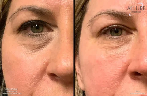 Close-up comparison showing a woman's eye area before and after a cosmetic procedure. The right image shows reduced wrinkles and puffiness. Allure Medical logo and contact info are visible.