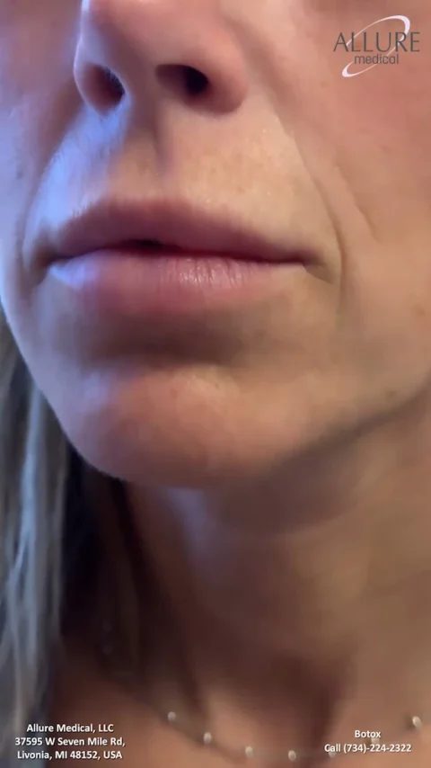 Close-up of the lower half of a face with the name and contact details of Allure Medical, LLC, and a text indicating "Botox.