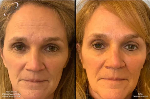 Before and after photo of a woman's face showcasing the effects of Botox treatment. The left side shows her face prior to treatment, while the right side displays the results after treatment.