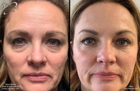 Side-by-side comparison of a woman's face before (left) and after (right) a cosmetic treatment, highlighting improved skin texture and reduced eye bags in the after photo.