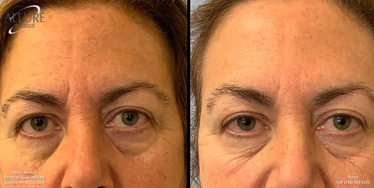 Side-by-side close-up images of a person’s face before and after a procedure, showing reduced under-eye bags and overall skin smoothness. The Allure Medical logo and contact details are visible.