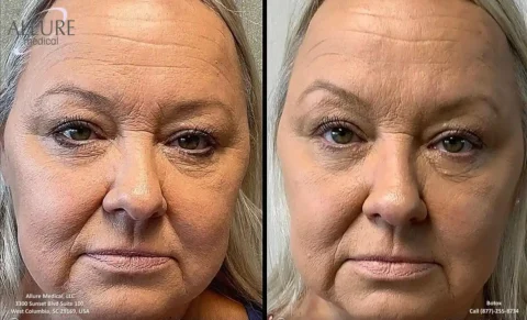 Side-by-side comparison of a woman's face showing a noticeable reduction in facial wrinkles and puffiness after cosmetic treatment. The left image shows the "before," and the right shows the "after.