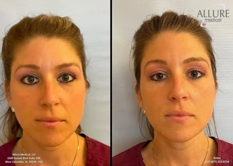 Side-by-side photos of a woman with slightly different facial expressions. Left image shows more pronounced eye makeup. Text includes "Allure Medical, LLC," location details, and a contact number for Botox inquiries.