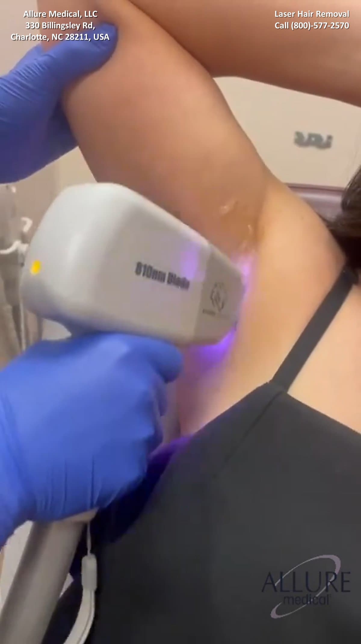 A healthcare professional in blue gloves is performing laser hair removal on a person's underarm using a 810nm diode machine at Allure Medical in Charlotte, NC.