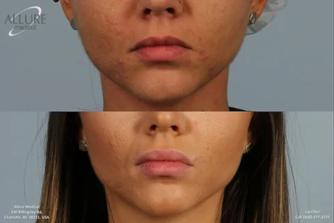 Comparison photo showing a woman's lower face before (top) and after (bottom) a lip filler procedure. The image highlights changes in lip volume and reduced acne.