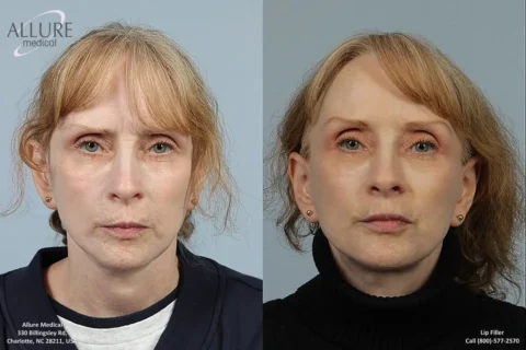 Before and after images of a woman showing the results of lip filler treatment. The left image shows her face before the procedure, and the right image shows her face after the procedure.