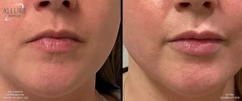 Before and after close-up images showing lips with improved volume and smoothness. Logos and contact information for Allure Medical are visible.