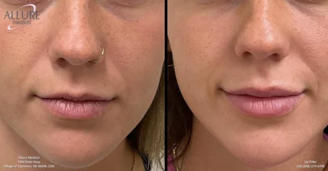 Side-by-side comparison of lips before and after a cosmetic procedure. The left image shows untreated lips with visible asymmetry, while the right image shows fuller, more symmetrical lips.